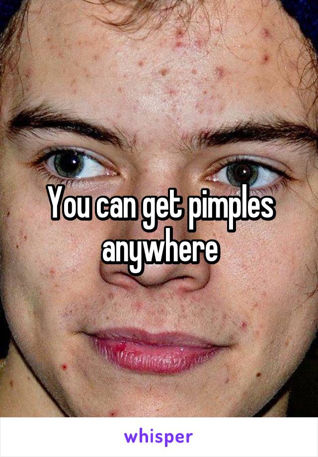 You can get pimples anywhere