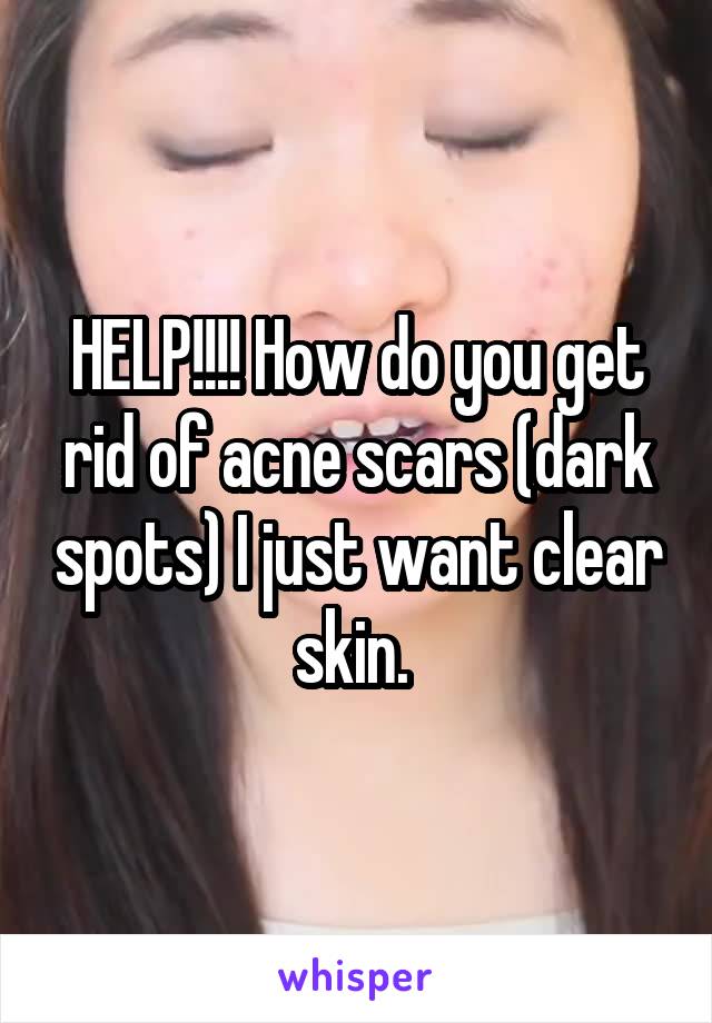 HELP!!!! How do you get rid of acne scars (dark spots) I just want clear skin. 