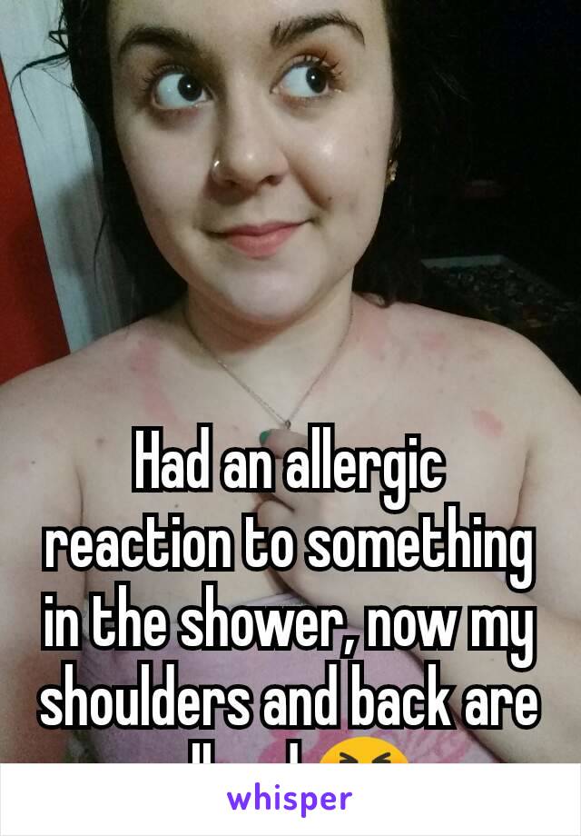 




Had an allergic reaction to something in the shower, now my shoulders and back are all red 😣