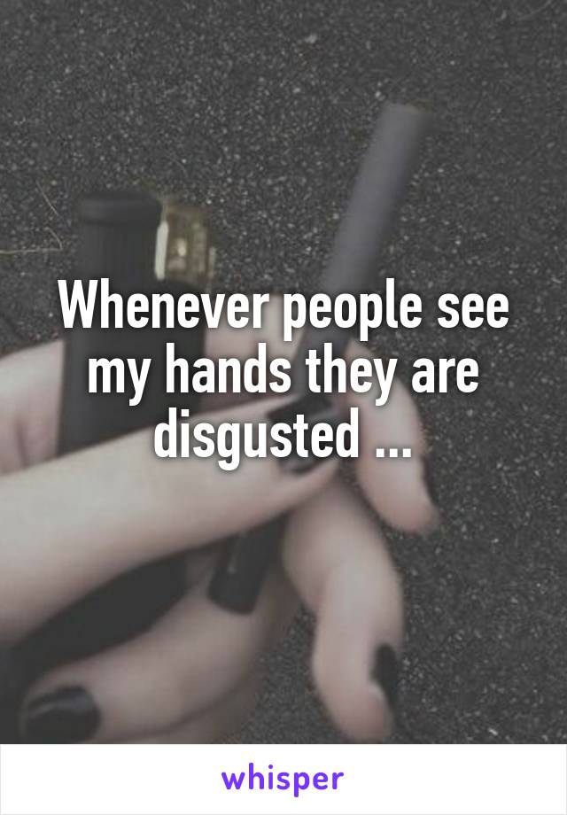 Whenever people see my hands they are disgusted ...

