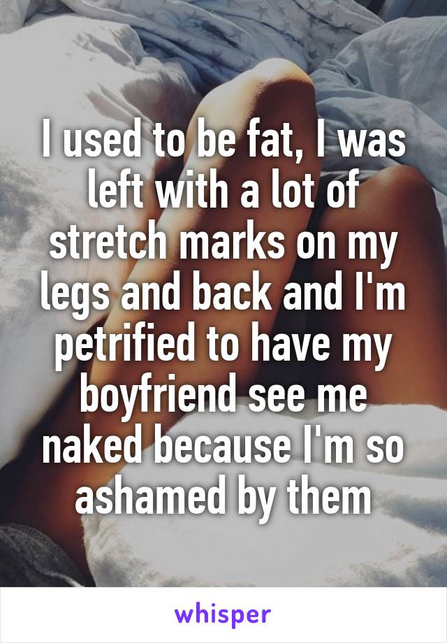 I used to be fat, I was left with a lot of stretch marks on my legs and back and I'm petrified to have my boyfriend see me naked because I'm so ashamed by them