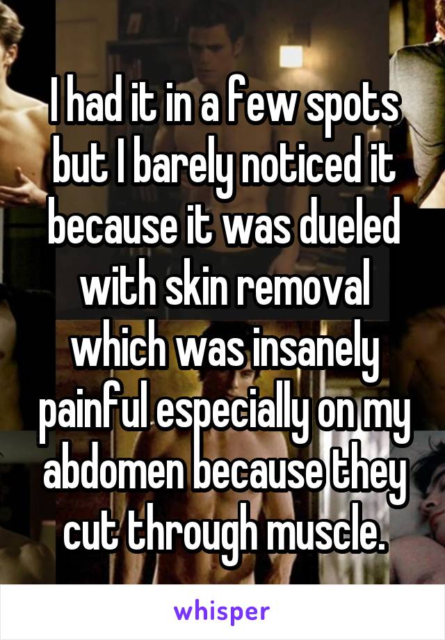 I had it in a few spots but I barely noticed it because it was dueled with skin removal which was insanely painful especially on my abdomen because they cut through muscle.