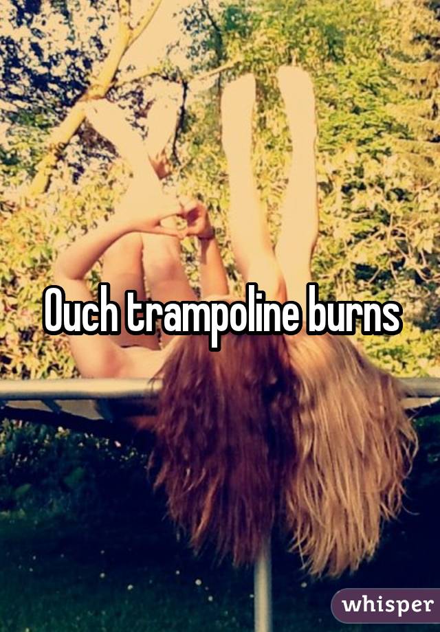 Ouch trampoline burns