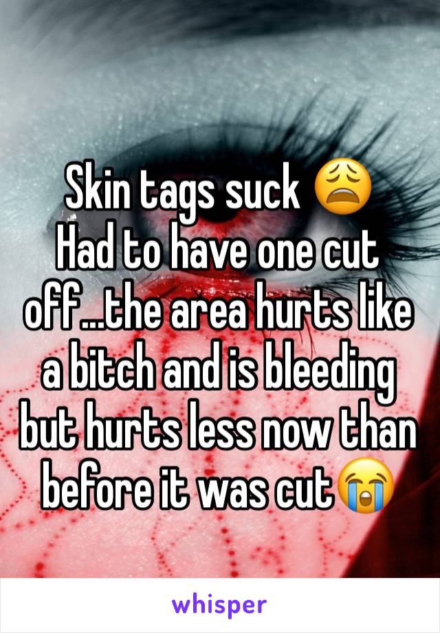 
Skin tags suck 😩
Had to have one cut off...the area hurts like a bitch and is bleeding but hurts less now than before it was cut😭