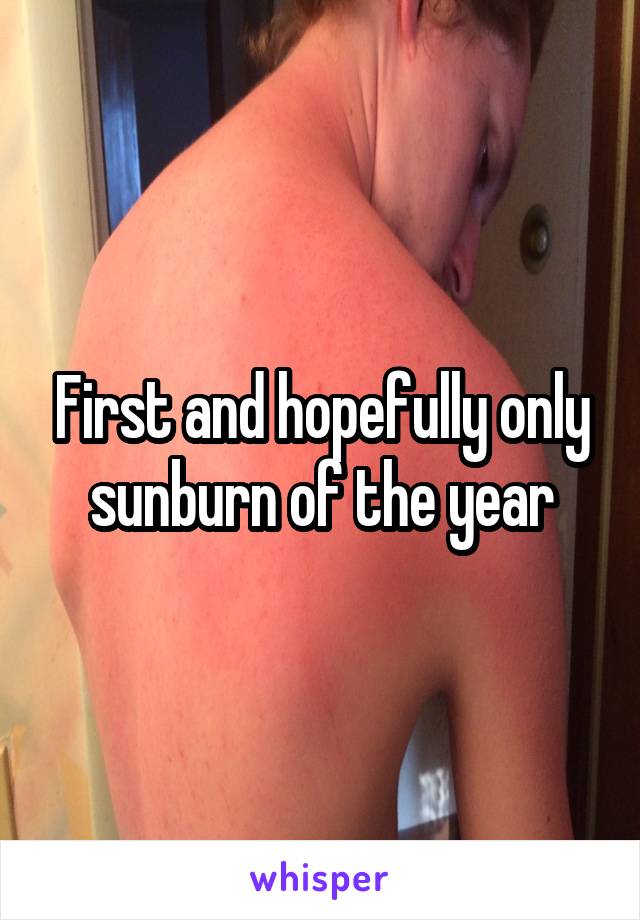 First and hopefully only sunburn of the year