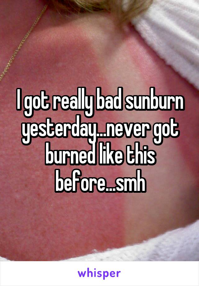 I got really bad sunburn yesterday...never got burned like this before...smh