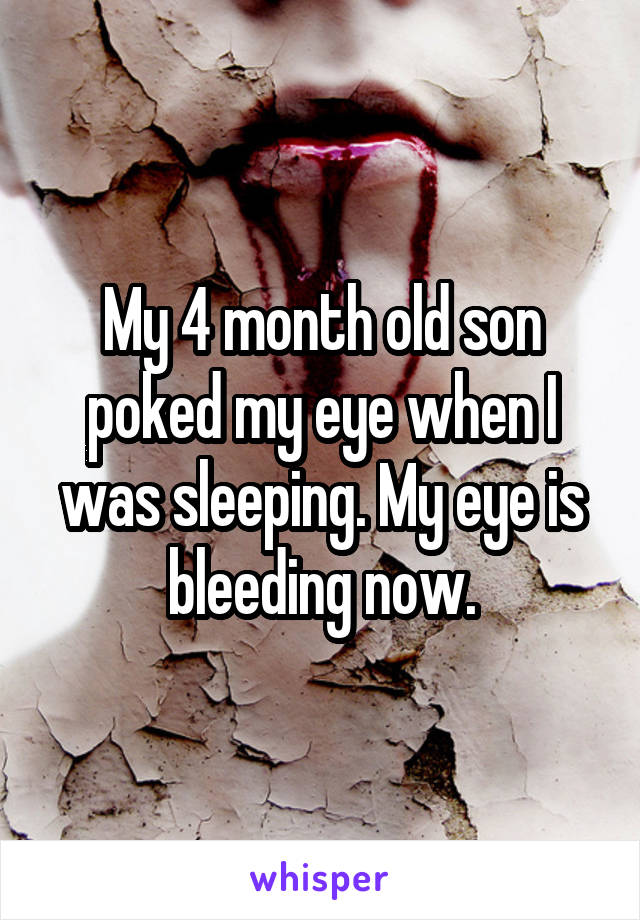 My 4 month old son poked my eye when I was sleeping. My eye is bleeding now.