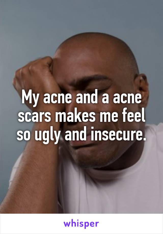 My acne and a acne scars makes me feel so ugly and insecure.