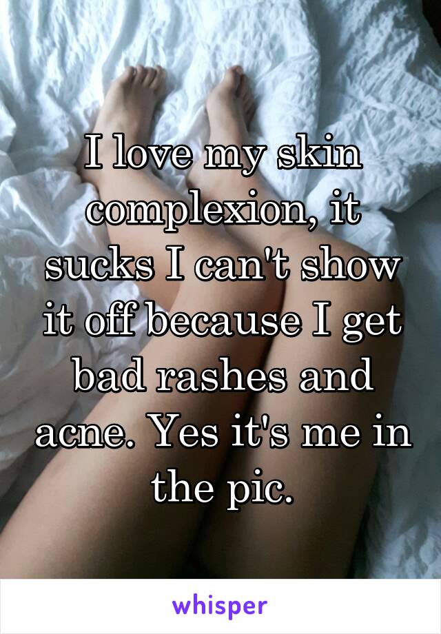 I love my skin complexion, it sucks I can't show it off because I get bad rashes and acne. Yes it's me in the pic.