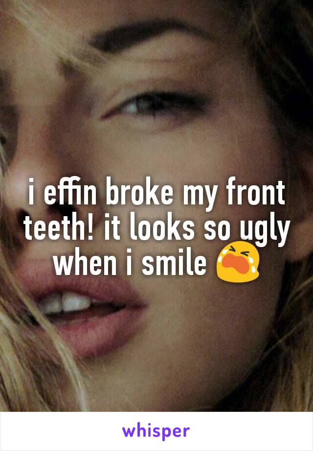 i effin broke my front teeth! it looks so ugly when i smile 😭