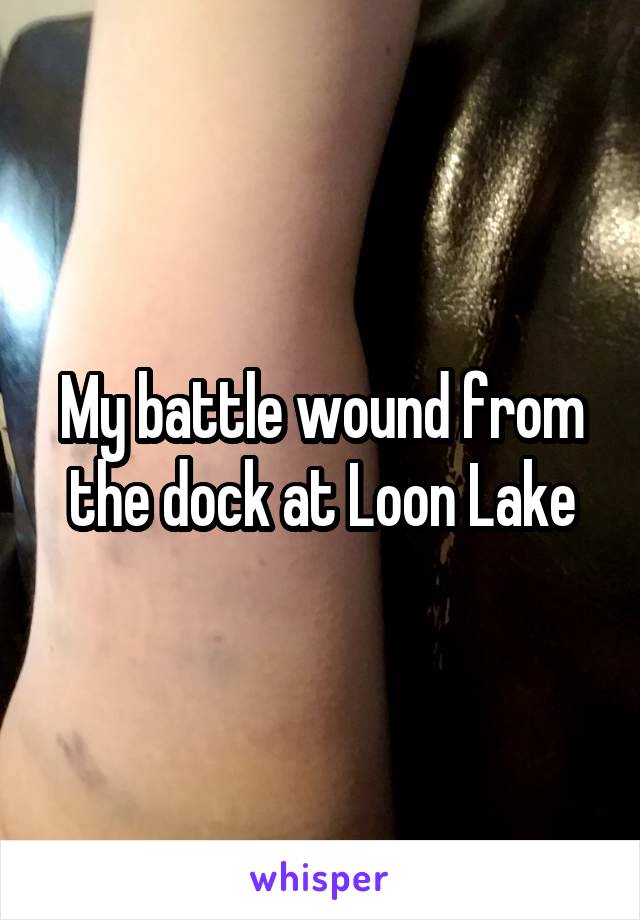 My battle wound from the dock at Loon Lake