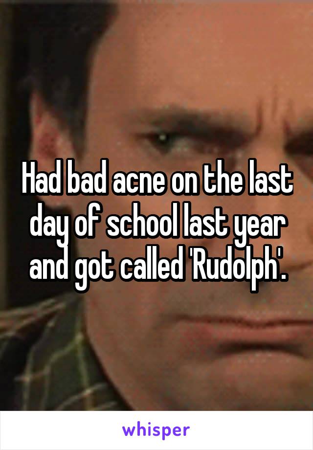 Had bad acne on the last day of school last year and got called 'Rudolph'.