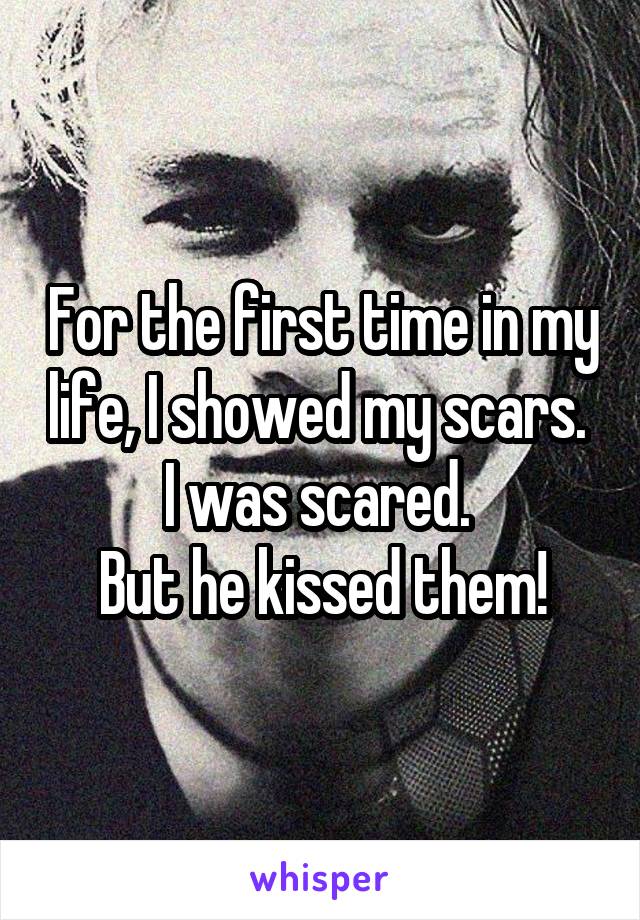 For the first time in my life, I showed my scars. 
I was scared. 
But he kissed them!