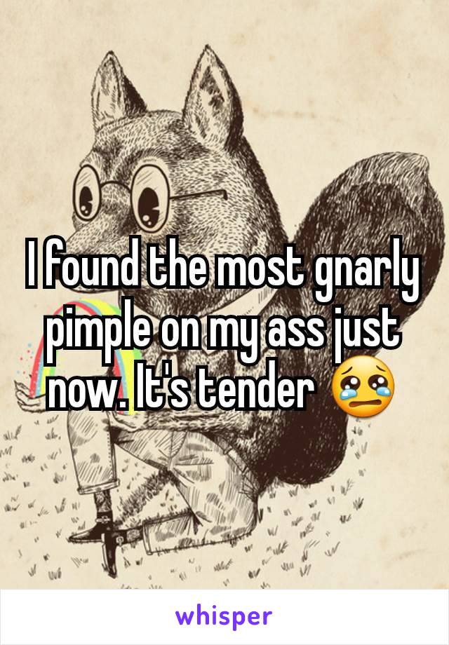 I found the most gnarly pimple on my ass just now. It's tender 😢