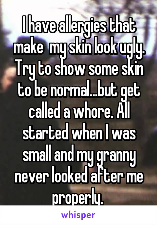 I have allergies that make  my skin look ugly. Try to show some skin to be normal...but get called a whore. All started when I was small and my granny never looked after me properly. 