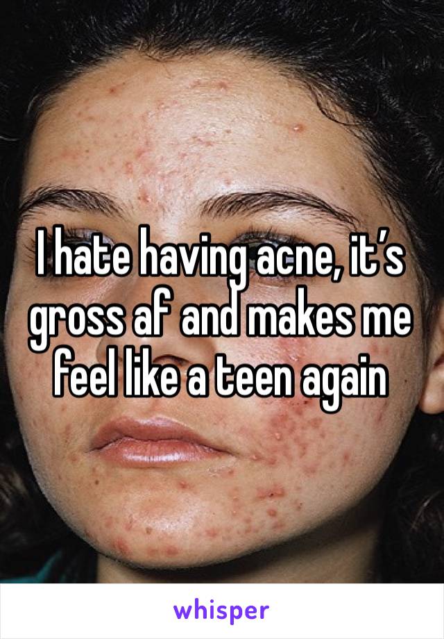 I hate having acne, it’s gross af and makes me feel like a teen again