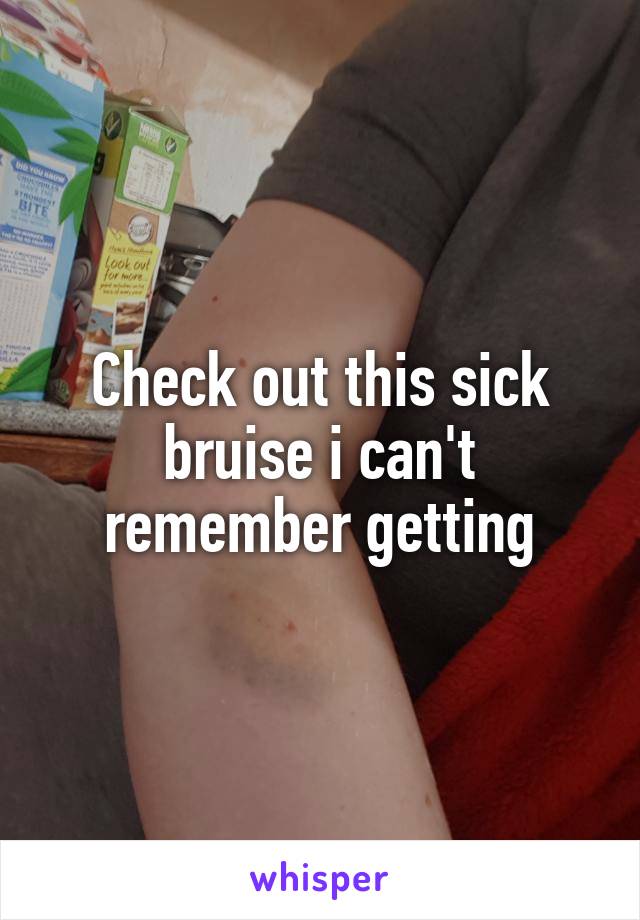 Check out this sick bruise i can't remember getting