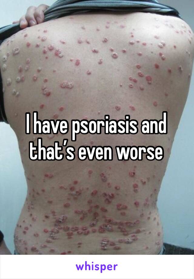 I have psoriasis and that’s even worse 