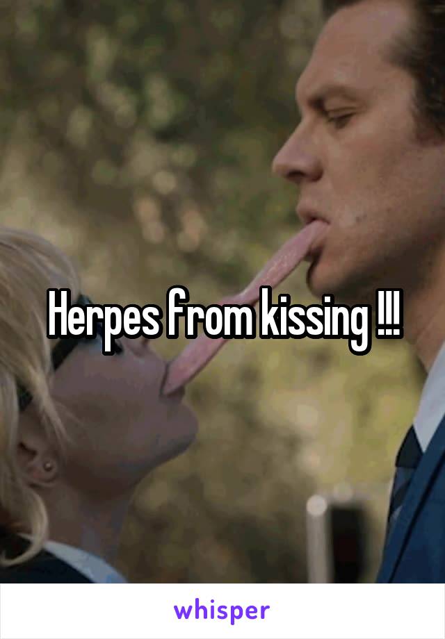 Herpes from kissing !!!