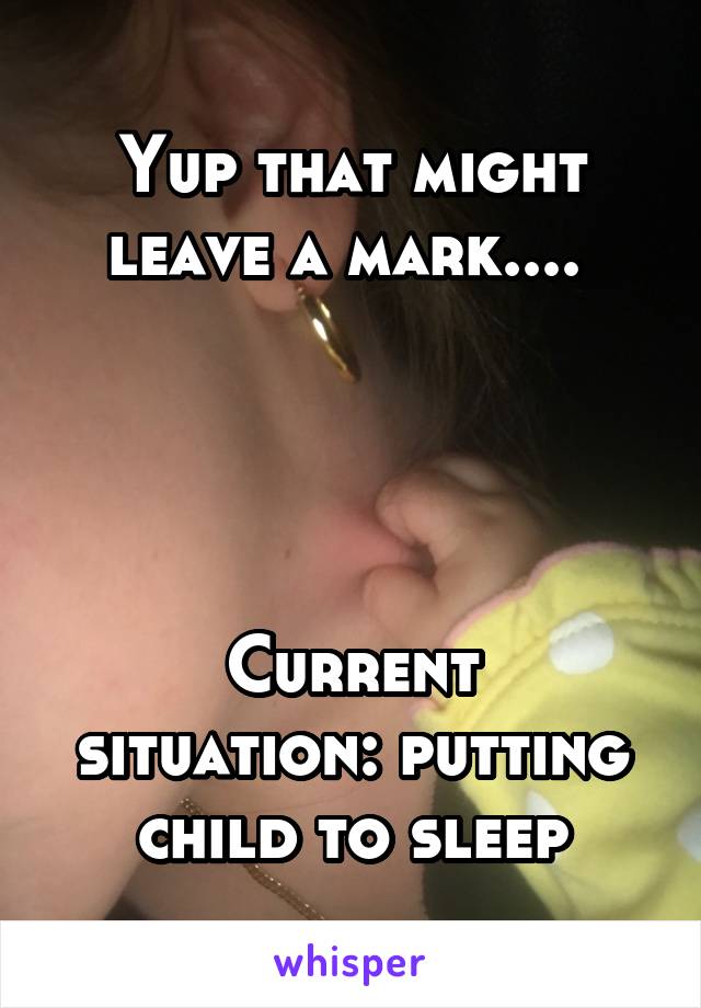 Yup that might leave a mark.... 




Current situation: putting child to sleep