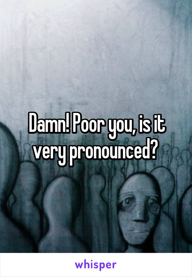 Damn! Poor you, is it very pronounced? 