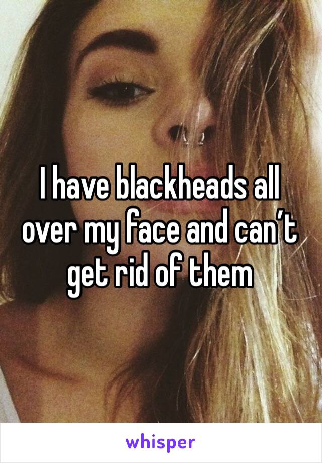 I have blackheads all over my face and can’t get rid of them 