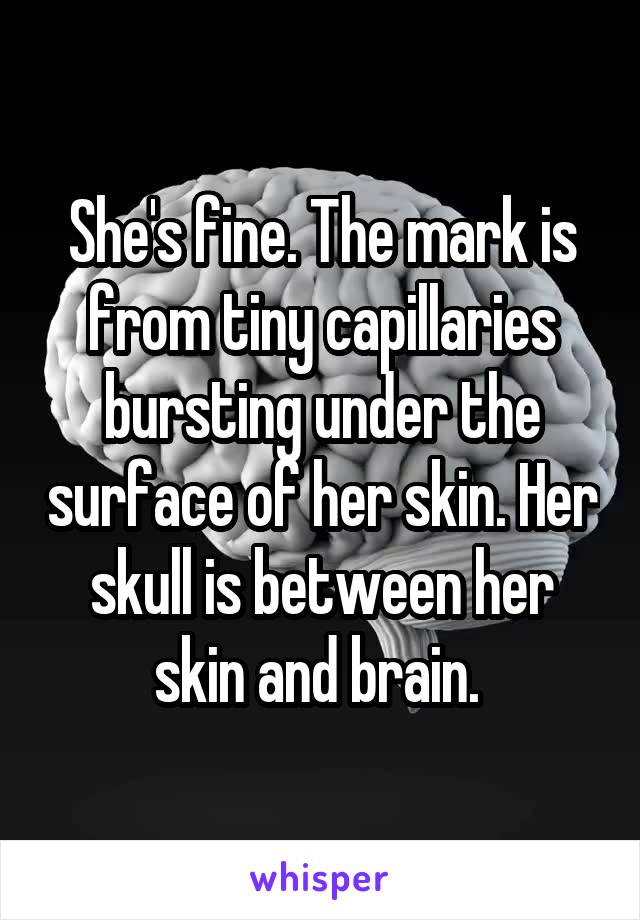 She's fine. The mark is from tiny capillaries bursting under the surface of her skin. Her skull is between her skin and brain. 