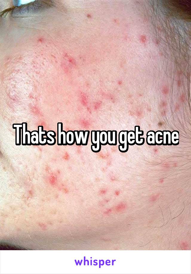 Thats how you get acne