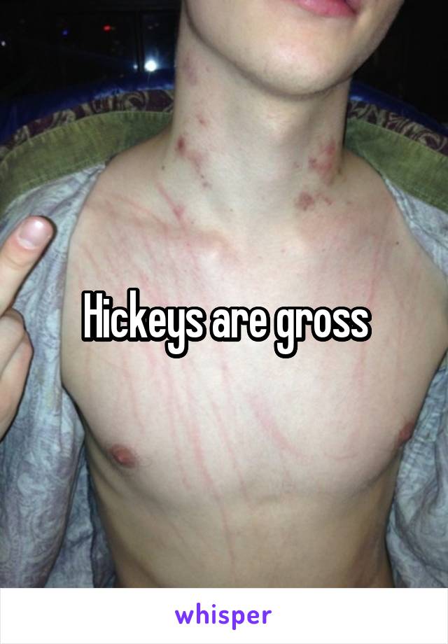 Hickeys are gross