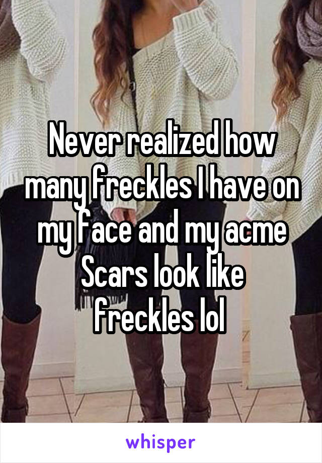 Never realized how many freckles I have on my face and my acme
Scars look like freckles lol 