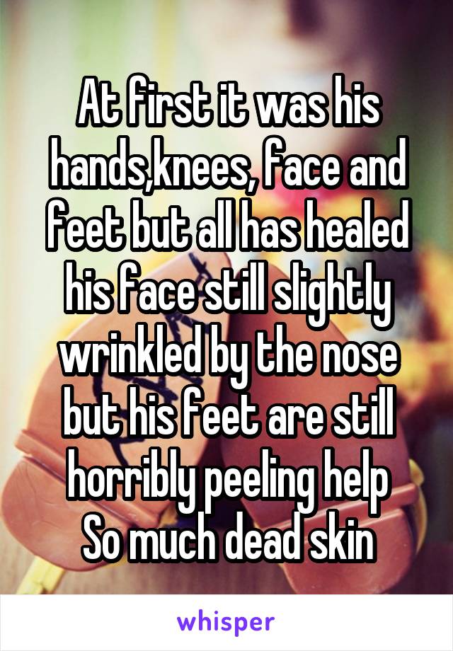At first it was his hands,knees, face and feet but all has healed his face still slightly wrinkled by the nose but his feet are still horribly peeling help
So much dead skin