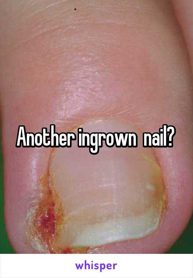 Another ingrown  nail? 