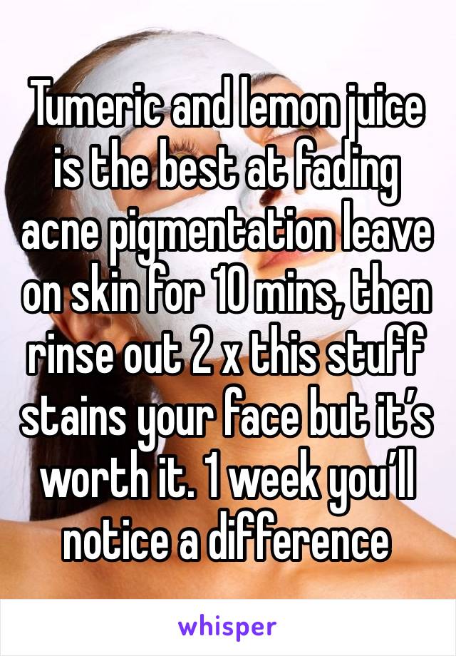 Tumeric and lemon juice is the best at fading acne pigmentation leave on skin for 10 mins, then rinse out 2 x this stuff stains your face but it’s worth it. 1 week you’ll 
notice a difference