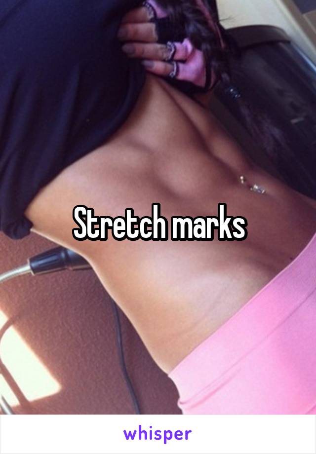 Stretch marks