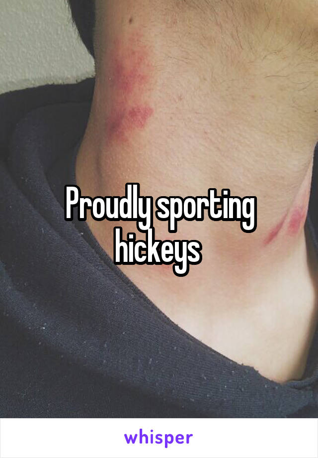 Proudly sporting hickeys 