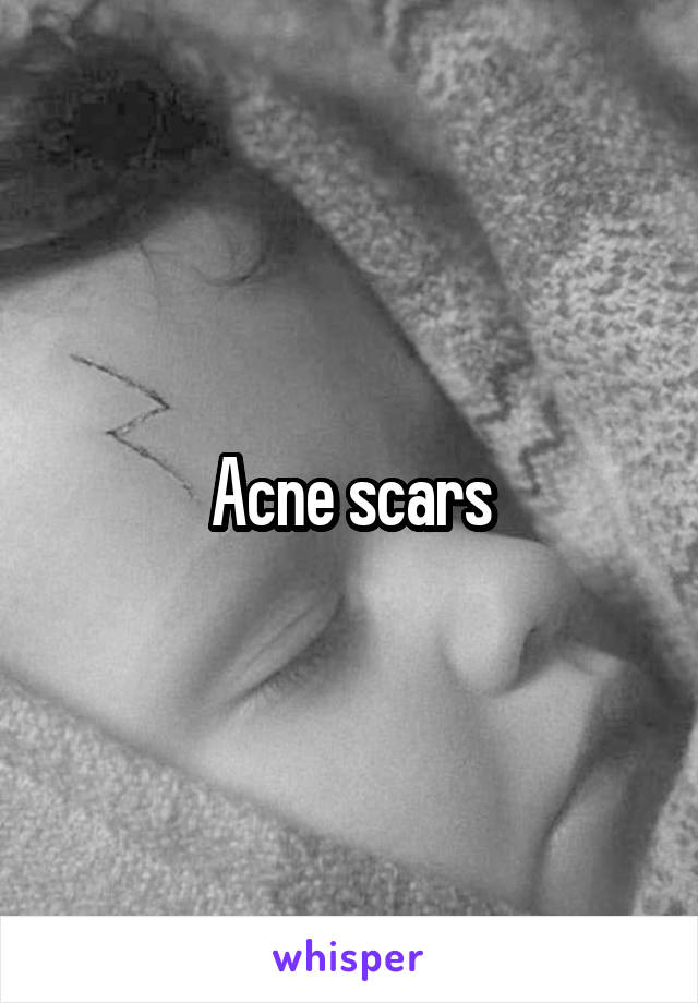 Acne scars