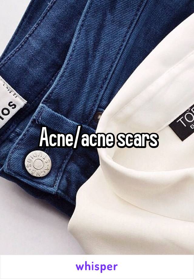 Acne/acne scars