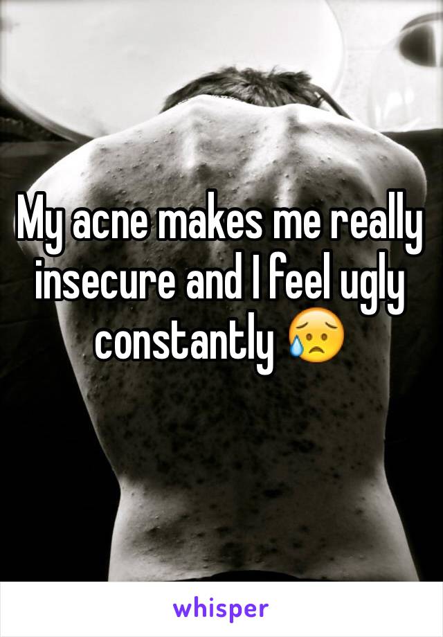 My acne makes me really insecure and I feel ugly constantly 😥