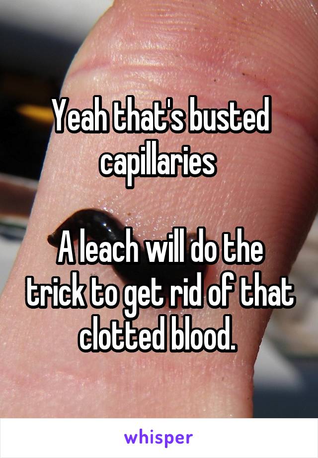 Yeah that's busted capillaries 

A leach will do the trick to get rid of that clotted blood. 