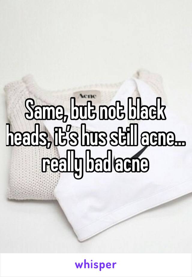 Same, but not black heads, it’s hus still acne... really bad acne