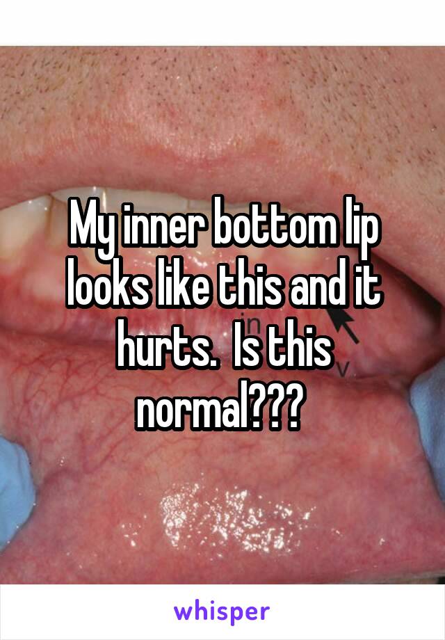 My inner bottom lip looks like this and it hurts.  Is this normal??? 