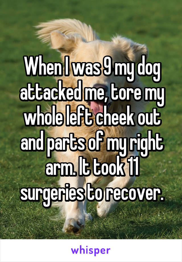 When I was 9 my dog attacked me, tore my whole left cheek out and parts of my right arm. It took 11 surgeries to recover.