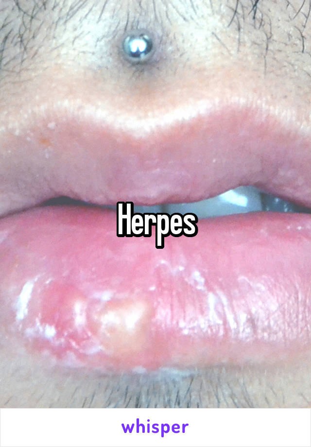 Herpes