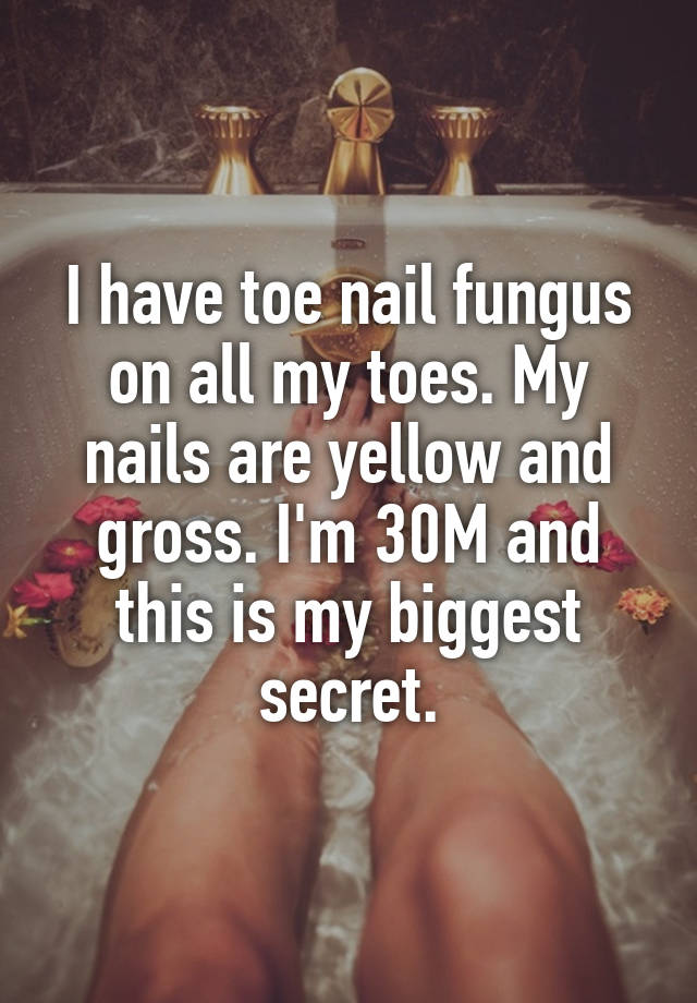 I have toe nail fungus on all my toes. My nails are yellow and gross. I'm 30M and this is my biggest secret.