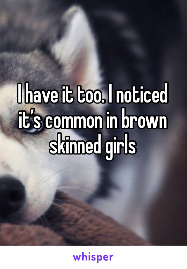 I have it too. I noticed it’s common in brown skinned girls 
