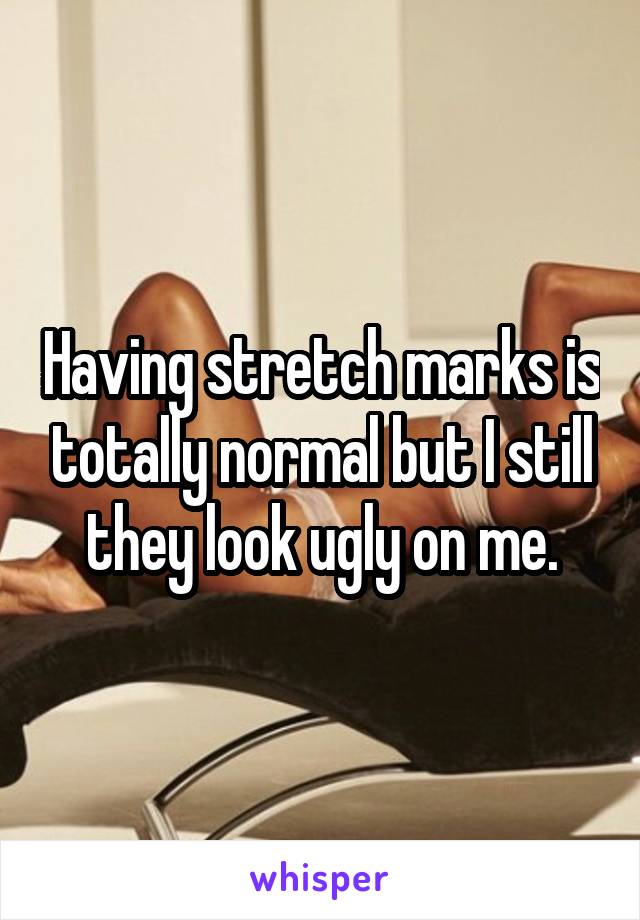 Having stretch marks is totally normal but I still they look ugly on me.