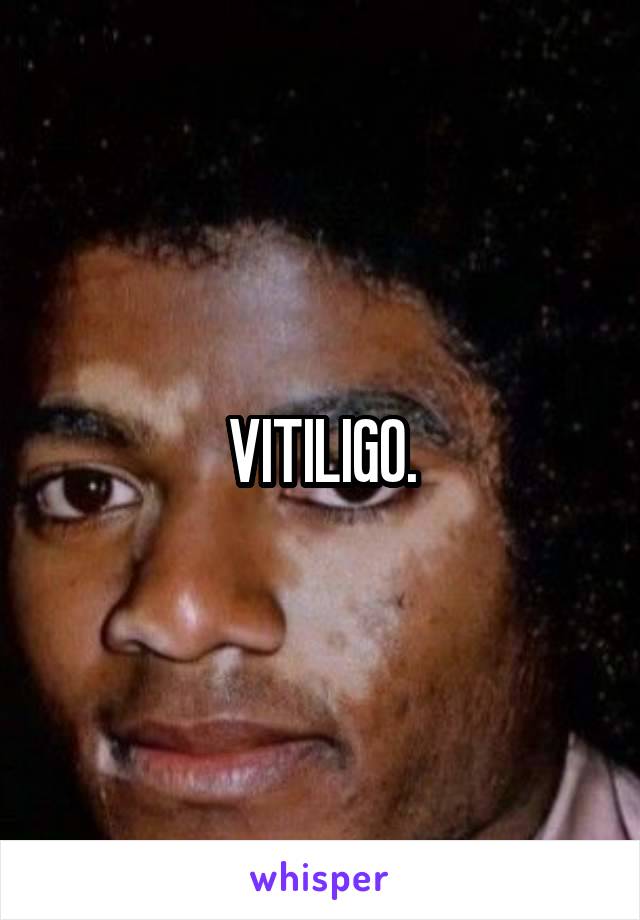 VITILIGO.