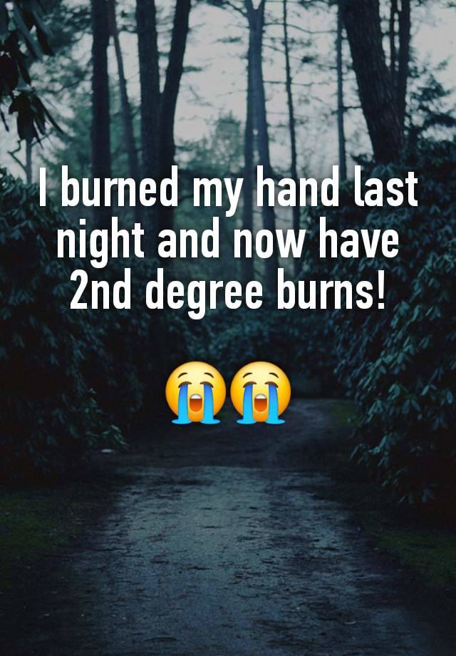 I burned my hand last night and now have 2nd degree burns!

😭😭